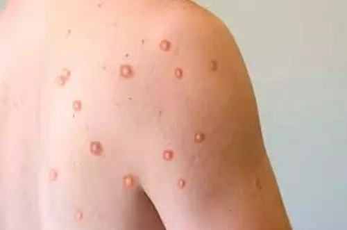 Confirman segundo caso de viruela del mono en Meta