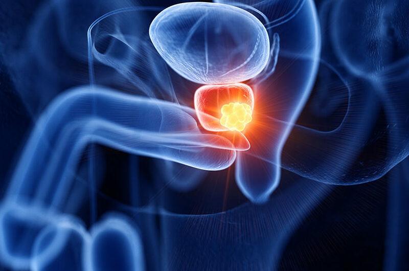 Cáncer de próstata: segunda enfermedad que más afecta hombre