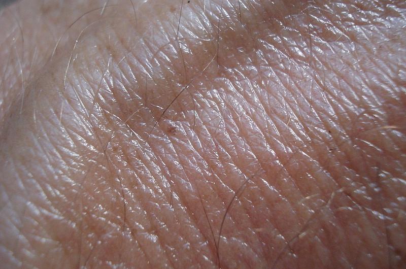 ¿Cómo prevenir el Cáncer de piel? 