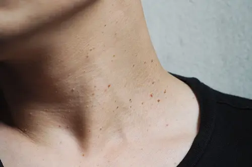 Verrugas en el cuello: causas ocultas y cómo prevenirlas