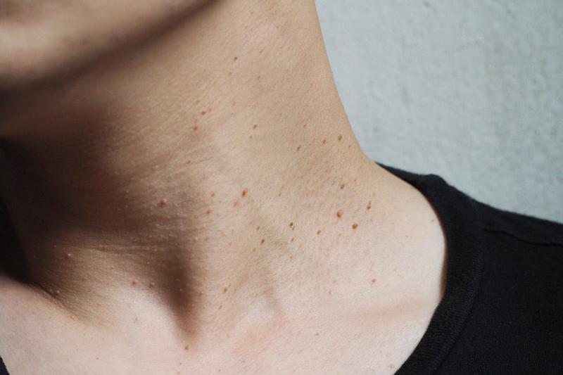 Verrugas en el cuello: causas ocultas y cómo prevenirlas