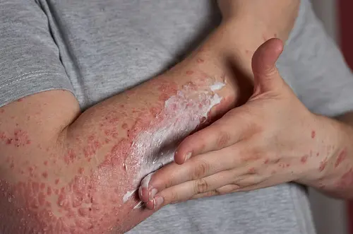 Colombia sostiene su estatus libre de sarampión