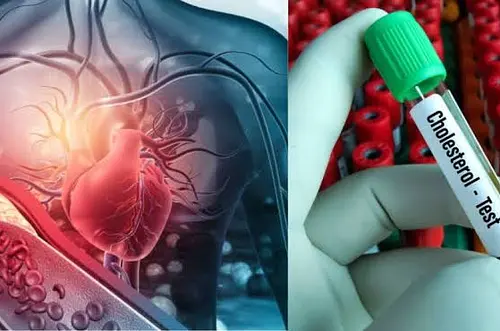 Nuevos límites del colesterol para evitar infartos y daños