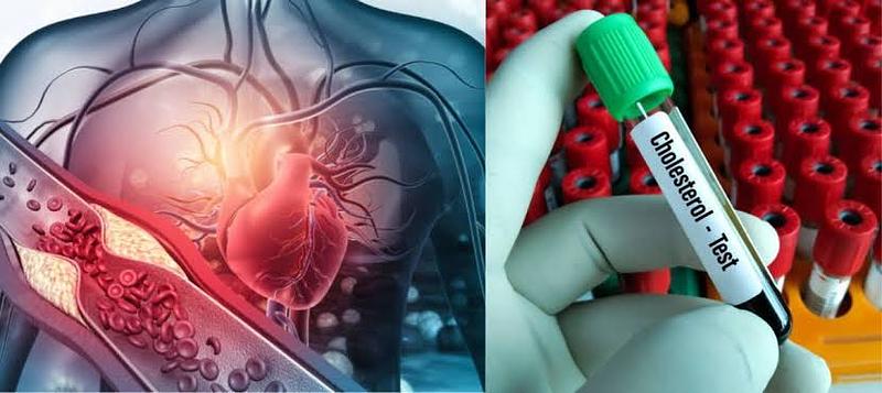 Nuevos límites del colesterol para evitar infartos y daños