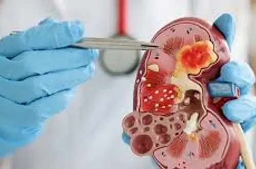 Alerta por enfermedad renal silenciosa en el país