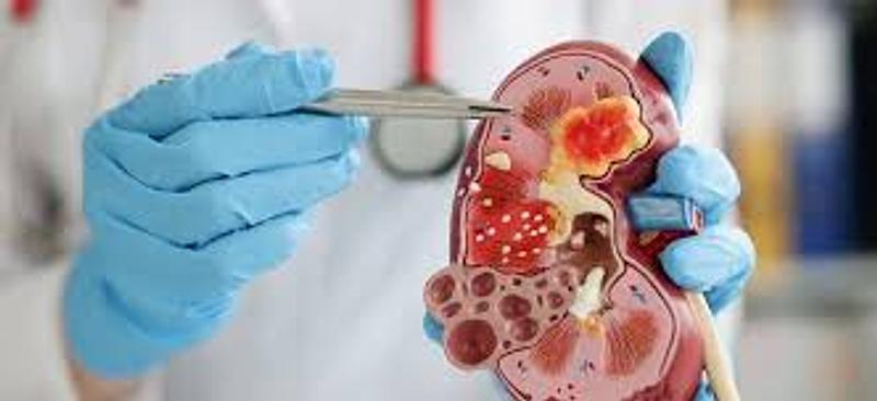 Alerta por enfermedad renal silenciosa en el país