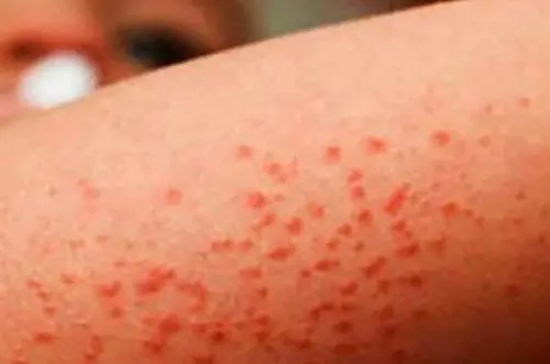 Se confirma quinto caso de sarampión importado en Colombia