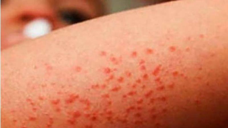 Se confirma quinto caso de sarampión importado en Colombia